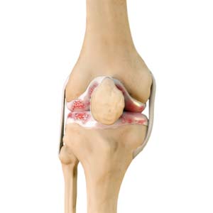 Knee Arthritis & Osteoarthritis