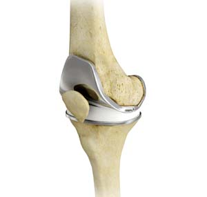 Knee Replacement