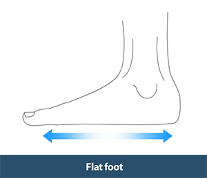 Flat Foot