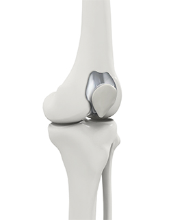 Patello Femoral Joint Replacement 