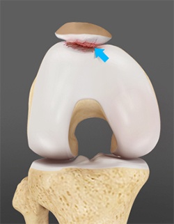 Patello Femoral Joint Replacement 