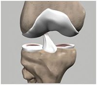 Ligament Injuries