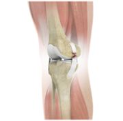 Ligament Injuries