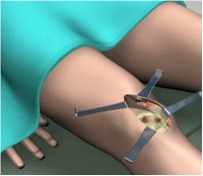 Osteoarthritis (OA)