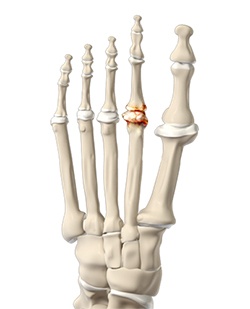 Osteoarthritis PRP