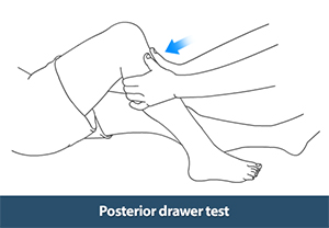 Posterior Drawer