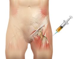 Platelet Rich Plasma Therapy
