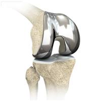 Total Knee Replacement