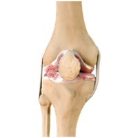 Total Knee Replacement